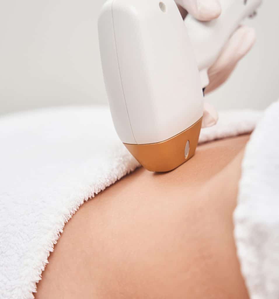 epilation laser sur peau