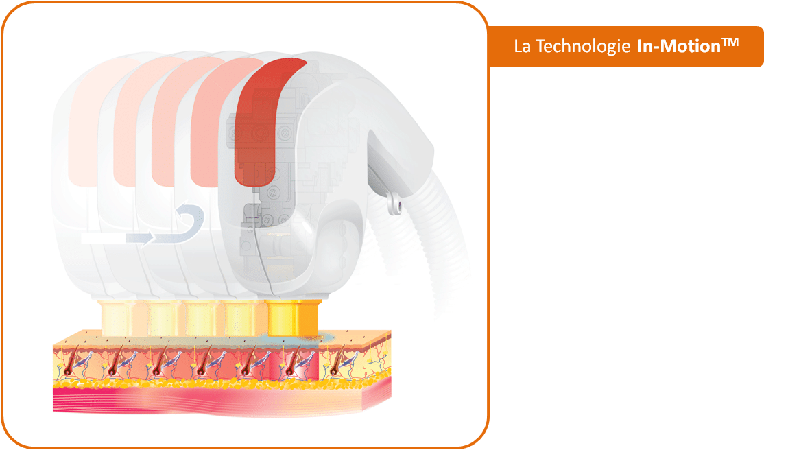 images d'épilation laser in-motion