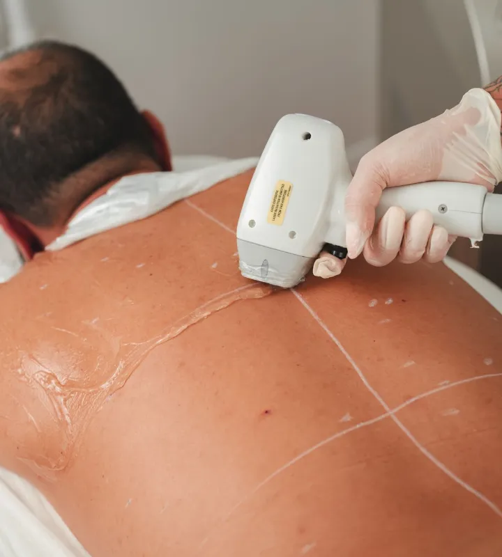 Épilation laser du dos pour homme à Aulnay-sous-Bois