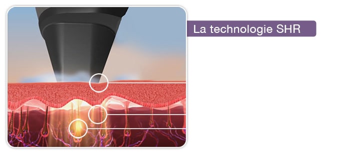 technologie SHR d'épilation laser