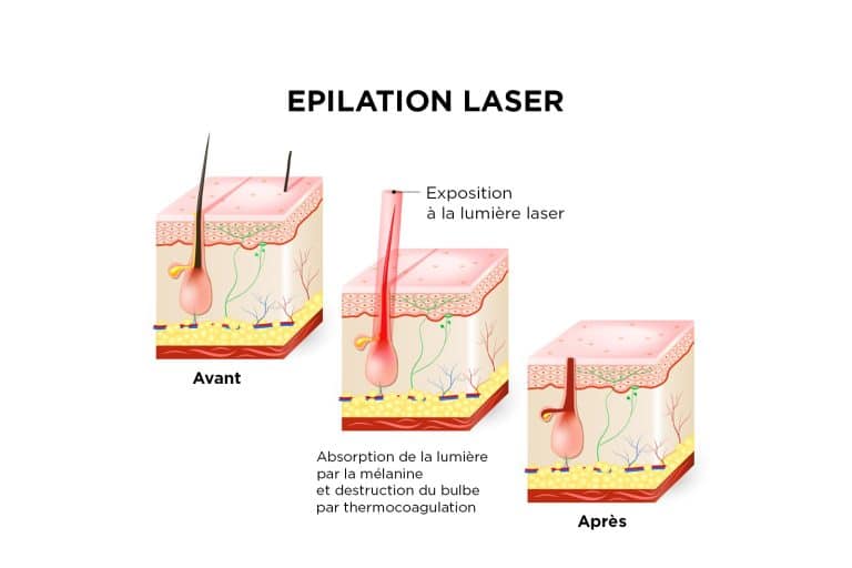 image explicative de l'épilation laser